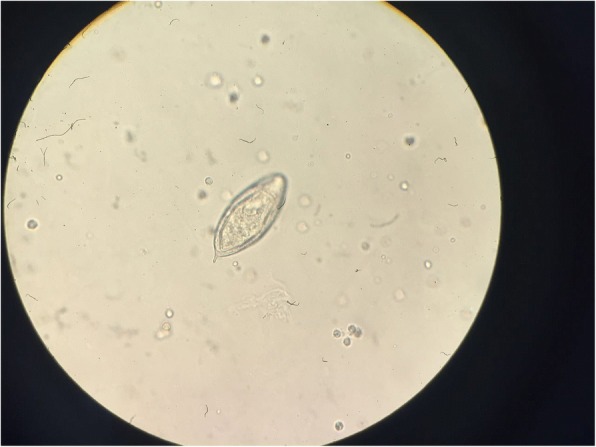 Urinary schistosomiasis: report of case diagnosed in bladder biopsy.