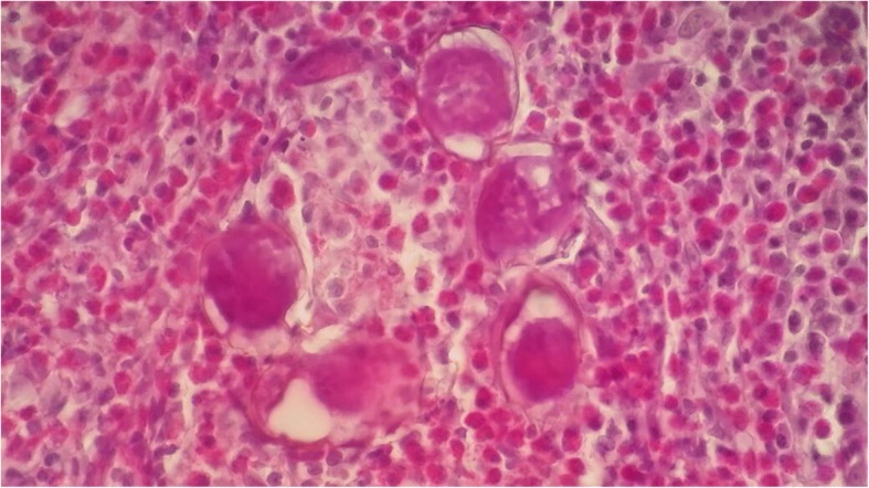 Urinary schistosomiasis: report of case diagnosed in bladder biopsy.