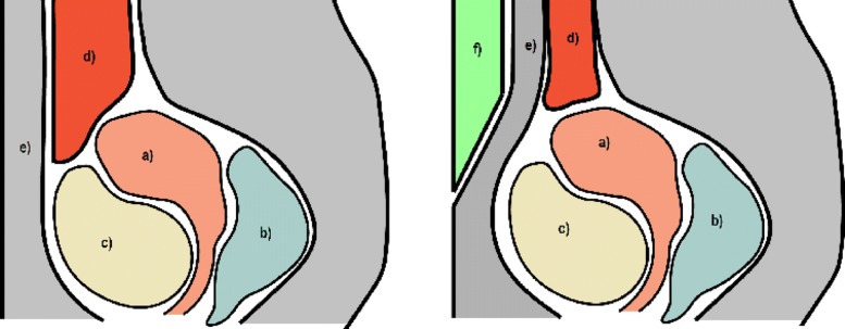 Wedged gel pad for bowel manipulation during MR-guided high-intensity focused ultrasound therapy to treat uterine fibroids: a case report.