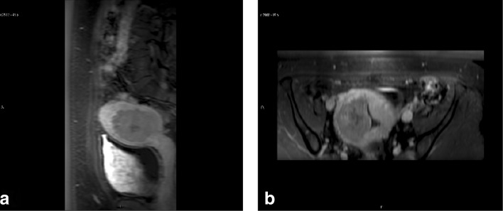 Wedged gel pad for bowel manipulation during MR-guided high-intensity focused ultrasound therapy to treat uterine fibroids: a case report.