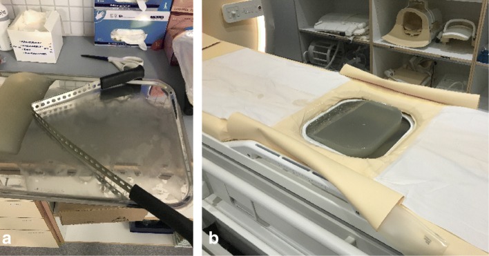 Wedged gel pad for bowel manipulation during MR-guided high-intensity focused ultrasound therapy to treat uterine fibroids: a case report.