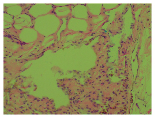 Trans Arterial Embolization of Spontaneous Intra-Abdominal Haemorrhage from Omental Lipoma.