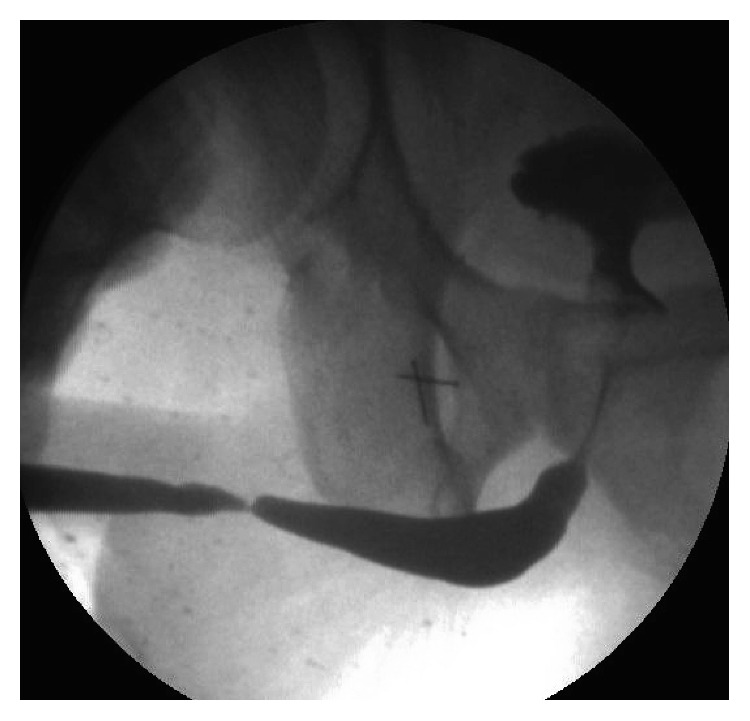 The Benefits of Using a Small Caliber Ureteroscope in Evaluation and Management of Urethral Stricture.