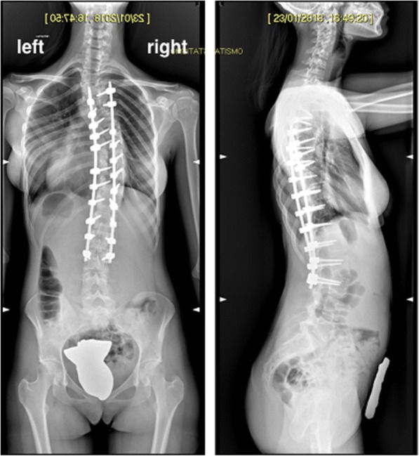 Acute pancreatitis after major spine surgery: a case report and literature review.