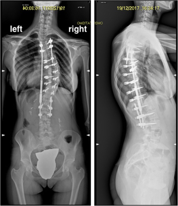 Acute pancreatitis after major spine surgery: a case report and literature review.