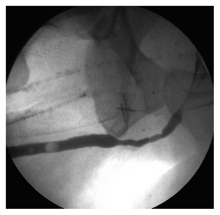 The Benefits of Using a Small Caliber Ureteroscope in Evaluation and Management of Urethral Stricture.