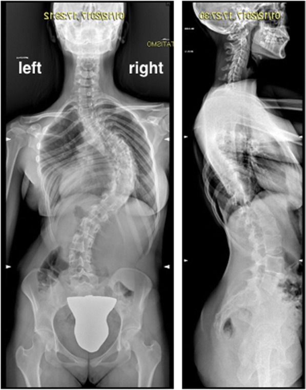 Acute pancreatitis after major spine surgery: a case report and literature review.