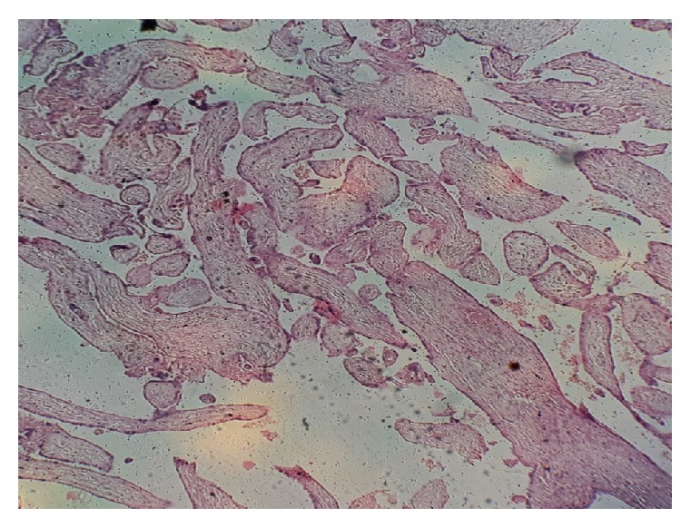 Histological Pattern of Endometrial Biopsies in Women with Abnormal Uterine Bleeding in a Hospital in North Central Nigeria.