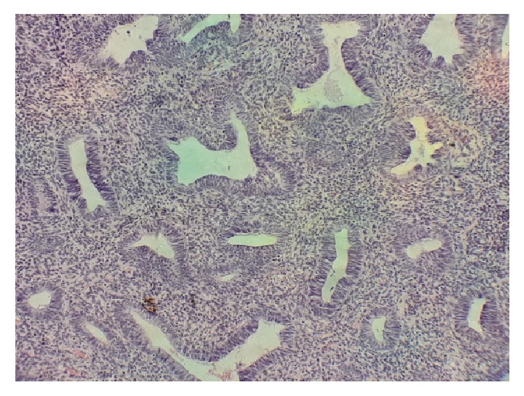 Histological Pattern of Endometrial Biopsies in Women with Abnormal Uterine Bleeding in a Hospital in North Central Nigeria.