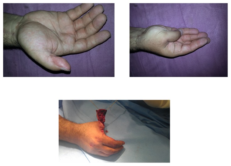 Salvaging Digital Replantation and Revascularisation: Efficiency of Heparin Solution Subcutaneous Injection.