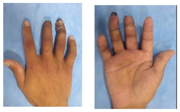Salvaging Digital Replantation and Revascularisation: Efficiency of Heparin Solution Subcutaneous Injection.