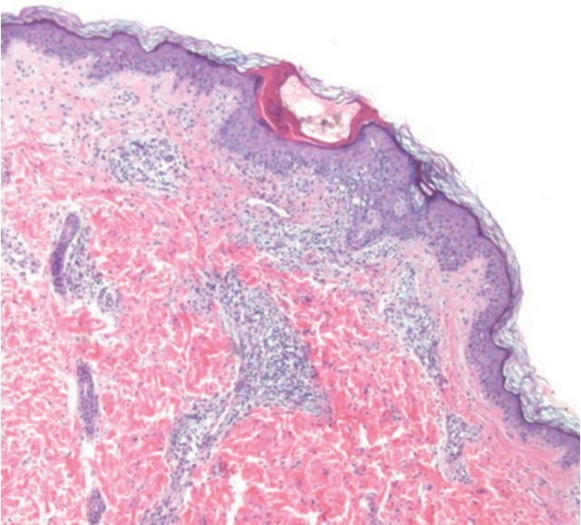 Scabies mimicking graft versus host disease in a hematopoietic cell transplant recipient.