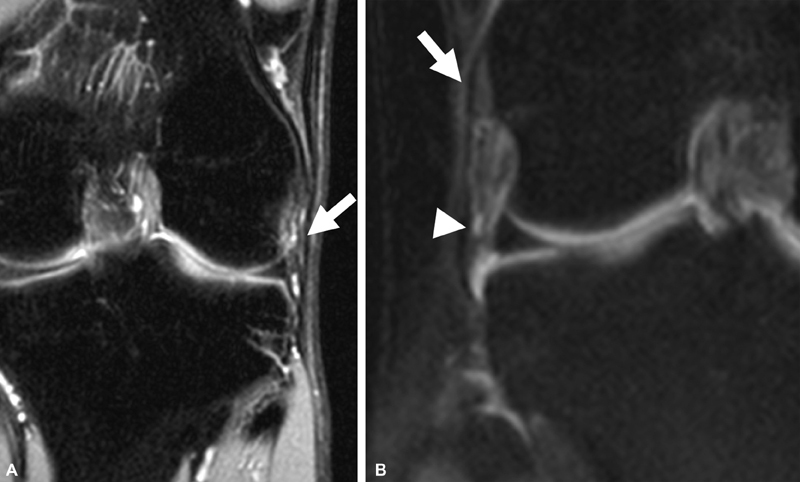 Assessment of the Anterolateral Ligament of the Knee by Magnetic Resonance Imaging.