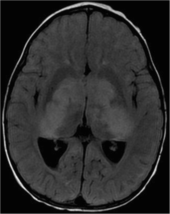 Cerebellar radiological abnormalities in children with neurofibromatosis type 1: part 1 - clinical and neuroimaging findings.