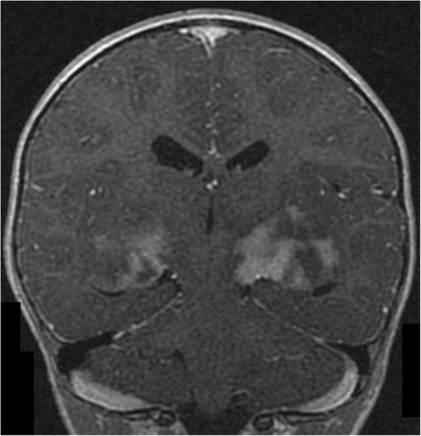 Cerebellar radiological abnormalities in children with neurofibromatosis type 1: part 1 - clinical and neuroimaging findings.