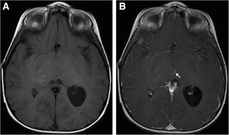 Cerebellar radiological abnormalities in children with neurofibromatosis type 1: part 1 - clinical and neuroimaging findings.