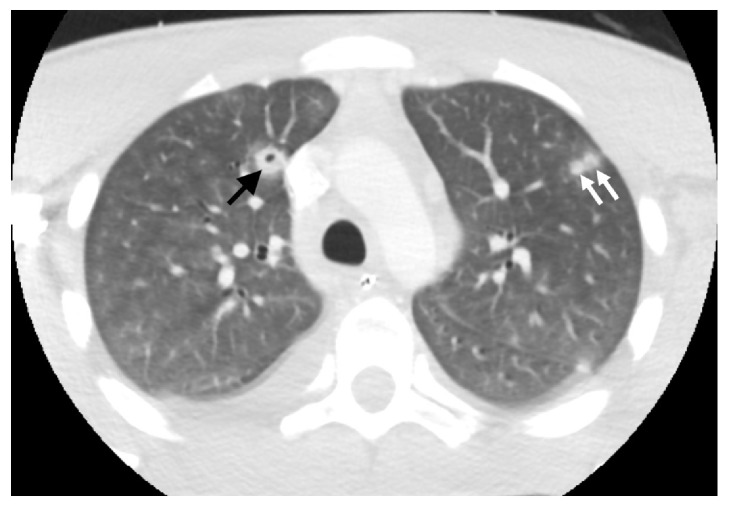 Sore Throat, Fever, Septic Emboli, and Acute Respiratory Distress Syndrome: A Case of Lemierre Syndrome.