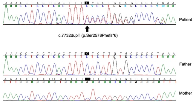 The first Korean case with Floating-Harbor syndrome with a novel SRCAP mutation diagnosed by targeted exome sequencing.