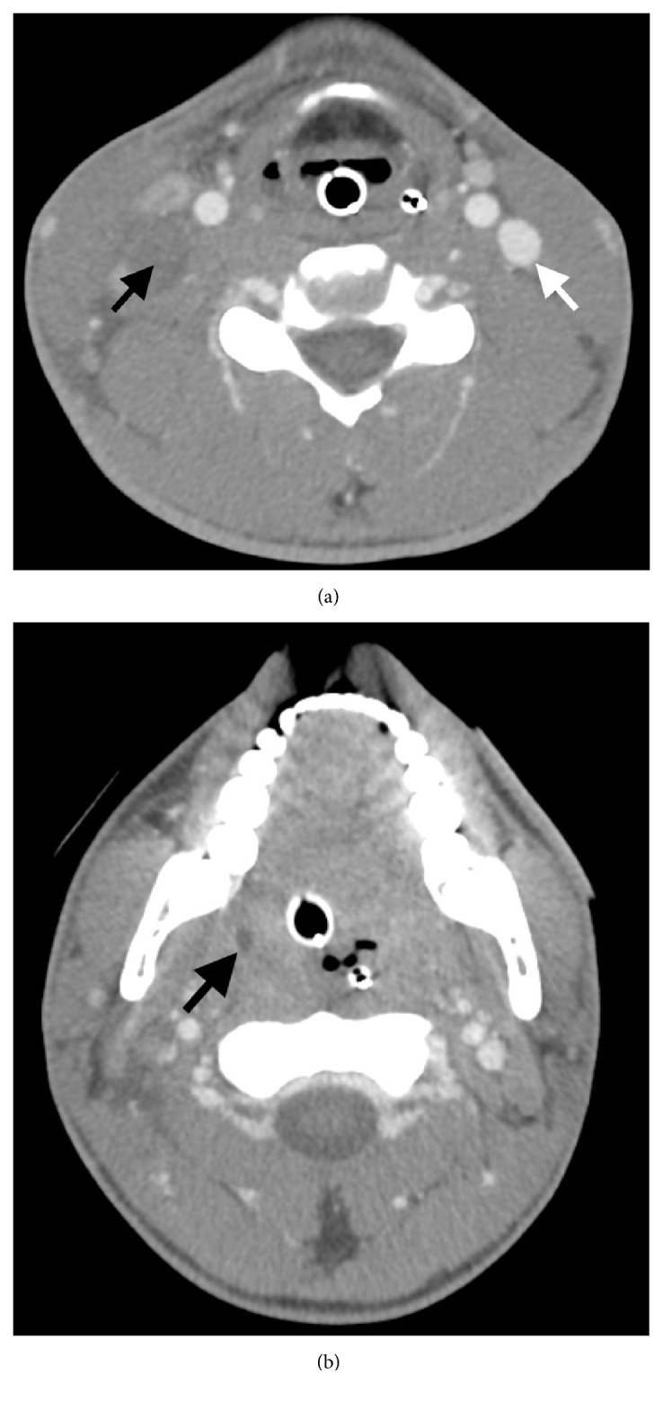 Sore Throat, Fever, Septic Emboli, and Acute Respiratory Distress Syndrome: A Case of Lemierre Syndrome.