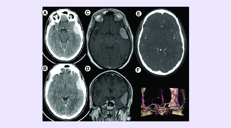 Grade II Sylvian fissure meningiomas without dural attachment: case report and review of the literature.