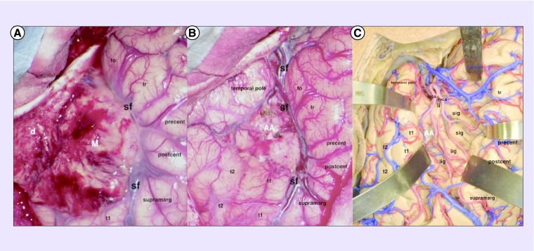 Grade II Sylvian fissure meningiomas without dural attachment: case report and review of the literature.