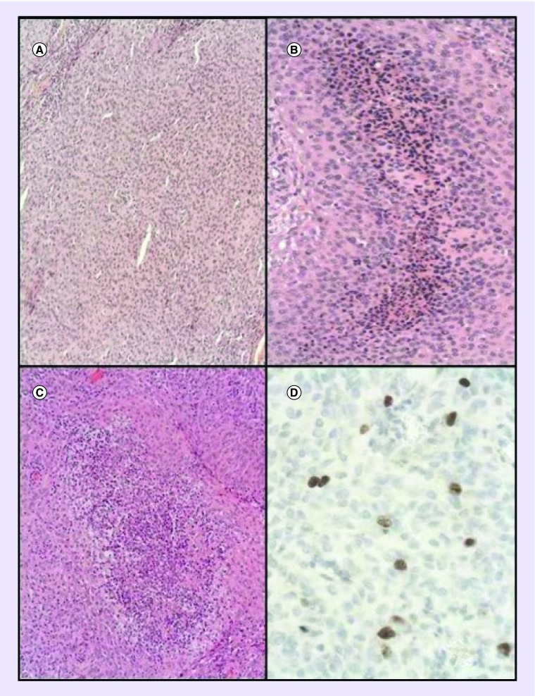 Grade II Sylvian fissure meningiomas without dural attachment: case report and review of the literature.