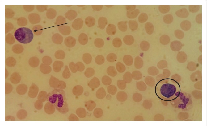 A case of a drug reaction to sulfasalazine in a patient infected with HIV.