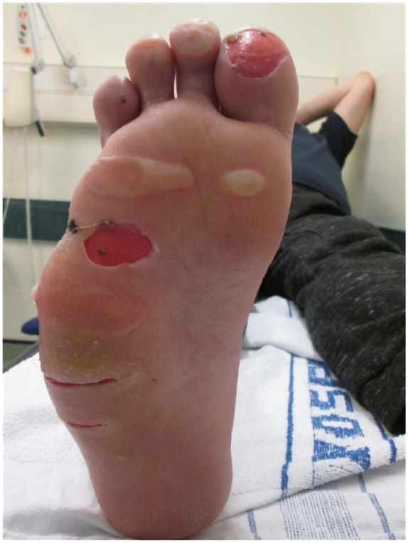 Limitations to the use of bromelain-based enzymatic debridement (NexoBrid<sup>®</sup>) for treating diabetic foot burns: a case series of disappointing results.