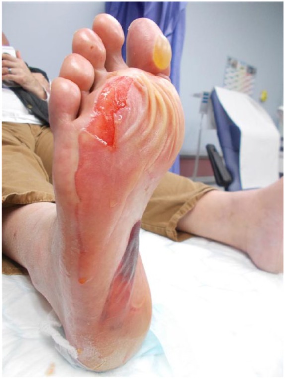 Limitations to the use of bromelain-based enzymatic debridement (NexoBrid<sup>®</sup>) for treating diabetic foot burns: a case series of disappointing results.