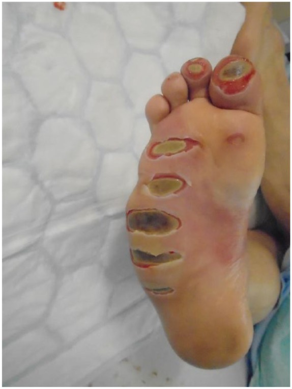 Limitations to the use of bromelain-based enzymatic debridement (NexoBrid<sup>®</sup>) for treating diabetic foot burns: a case series of disappointing results.