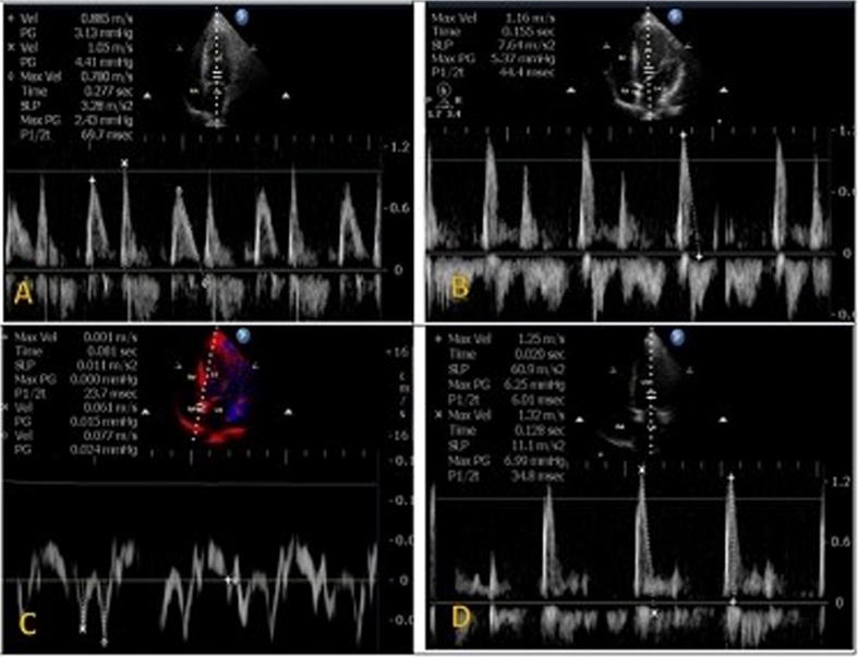 Acute effect of primary PCI on diastolic dysfunction recovery in anterior wall STEMI – A non-invasive evaluation by echocardiography