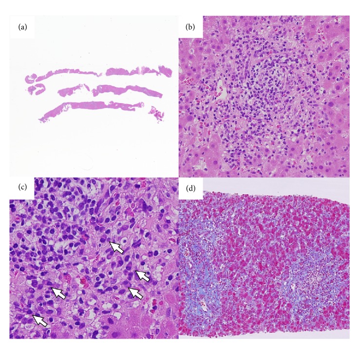 Autoimmune Hepatitis with Concomitant Idiopathic Thrombocytopenic Purpura Diagnosed by Transjugular Liver Biopsy.