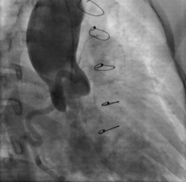 Congenital atresia of left main coronary artery