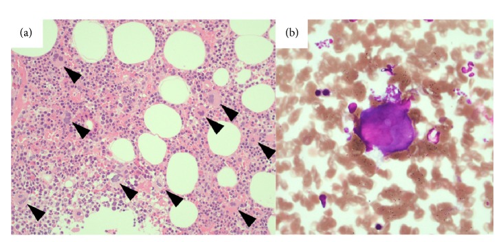 Autoimmune Hepatitis with Concomitant Idiopathic Thrombocytopenic Purpura Diagnosed by Transjugular Liver Biopsy.