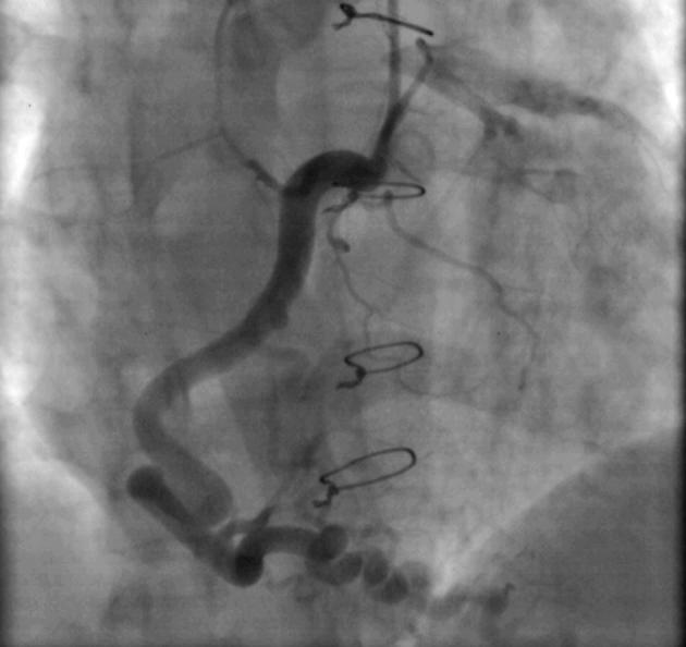 Congenital atresia of left main coronary artery