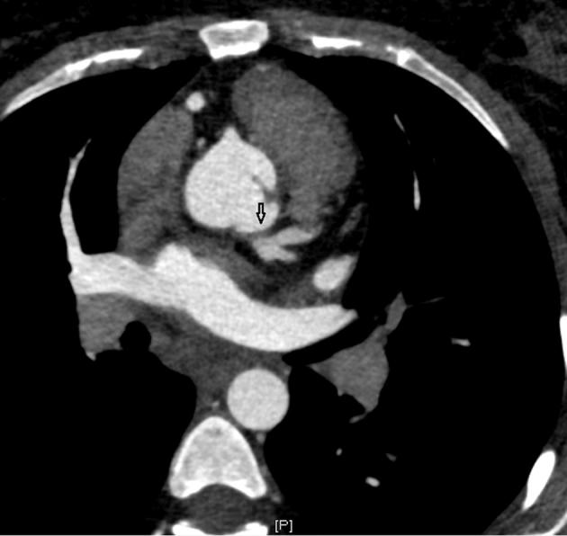 Congenital atresia of left main coronary artery