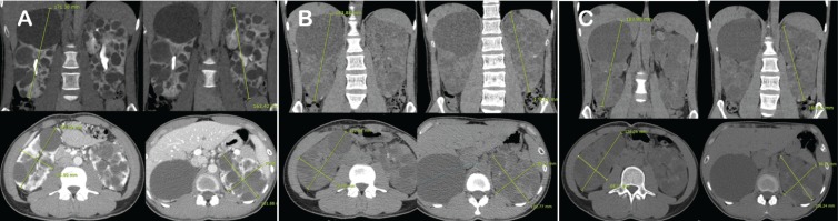 Long-term Tolvaptan Treatment of Autosomal Dominant Polycystic Kidney Disease in Korea.