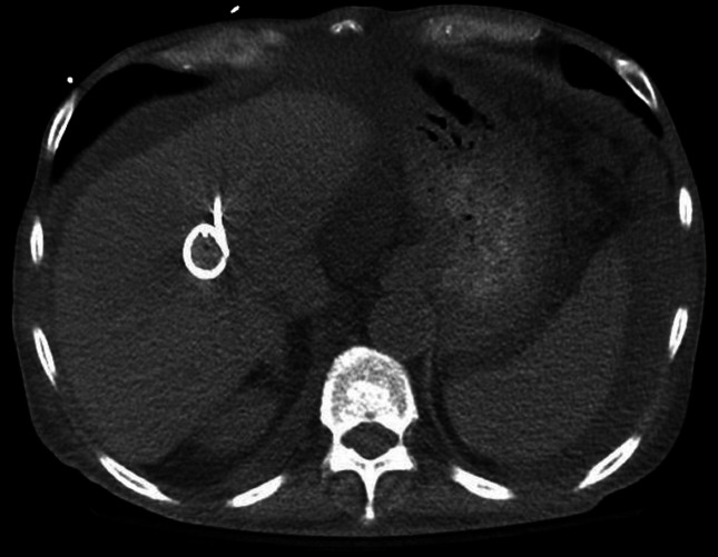 Multi-drug-resistant <i>Enterococcus faecium</i> bacteraemia in a liver transplant recipient.