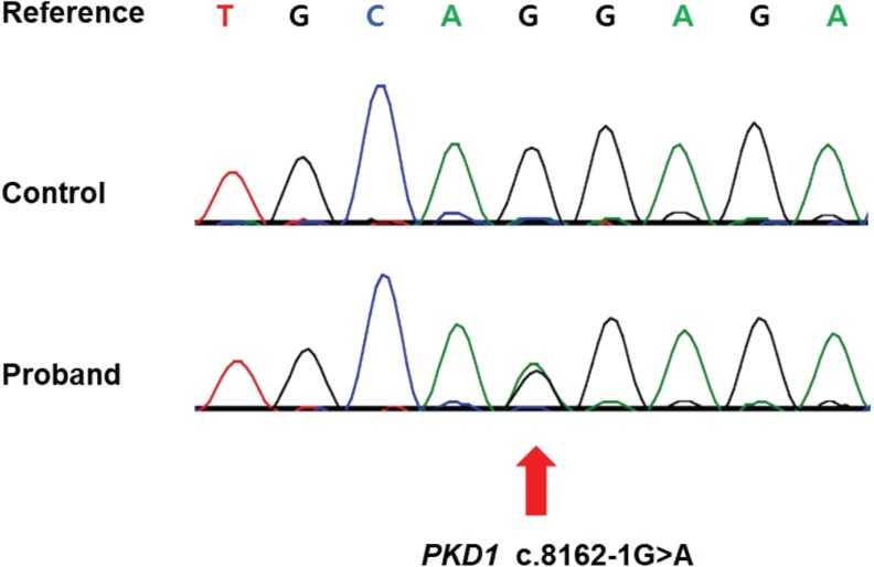 Long-term Tolvaptan Treatment of Autosomal Dominant Polycystic Kidney Disease in Korea.
