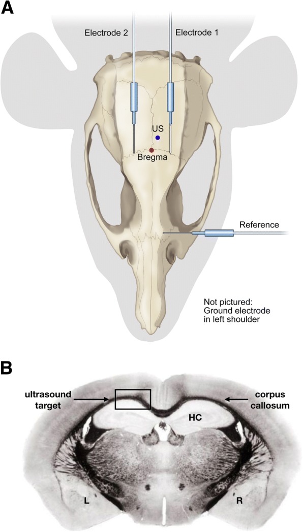 Transcranial and pulsed focused ultrasound that activates brain can accelerate remyelination in a mouse model of multiple sclerosis.