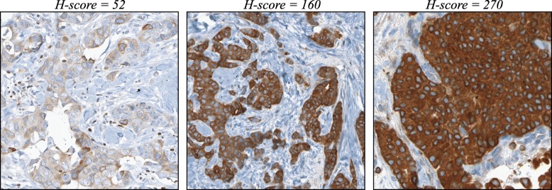 BCL-2 expression aids in the immunohistochemical prediction of the Oncotype DX breast cancer recurrence score.