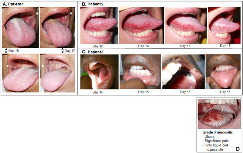 Reduction in oral mucositis severity using a topical vasoconstrictor: A case report of three bone marrow transplant patients.