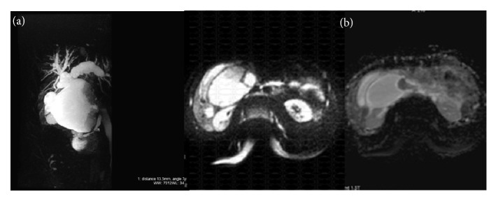 Contribution of Imaging in the Diagnosis of Cholangiocarcinoma in Choledochal Cyst.