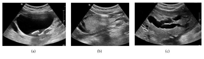 Contribution of Imaging in the Diagnosis of Cholangiocarcinoma in Choledochal Cyst.