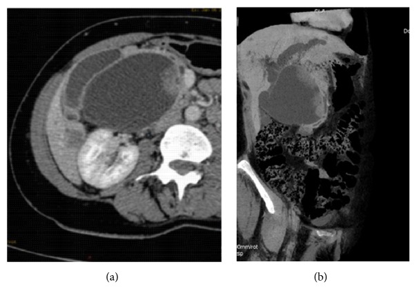 Contribution of Imaging in the Diagnosis of Cholangiocarcinoma in Choledochal Cyst.