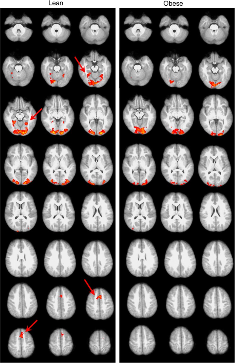 Brain activation to high-calorie food images in healthy normal weight and obese children: a fMRI study.