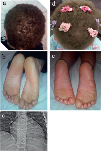 Novel desmoplakin mutations in familial Carvajal syndrome.