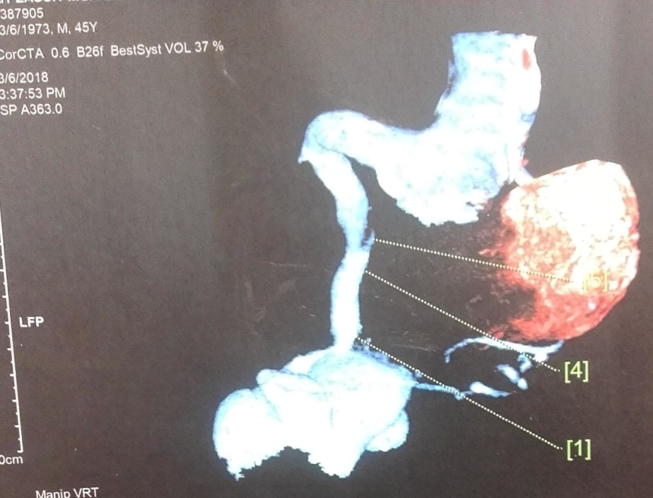 Coronaro-cameral fistula, case report and review of the literature