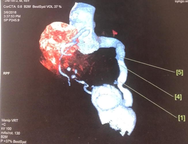 Coronaro-cameral fistula, case report and review of the literature