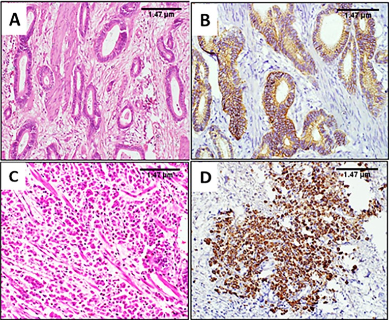 HER2 Oncogene Amplification and Immunohistochemical Profiling in Gastric Adenocarcinoma.